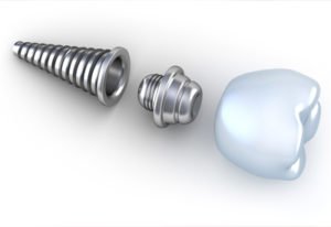 PDM_Pieces-of-Dental-Implants