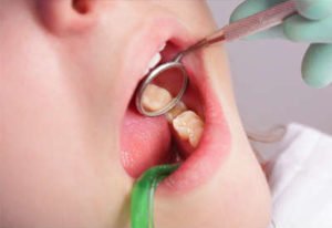 PDM_Composite-Fillings11