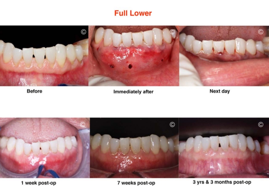Dr. Boyajian is certified to perform the Pinhole Surgical Technique in ...